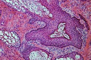 Cancer Services - Cancer Types - Dermatology Cancer - Introduction